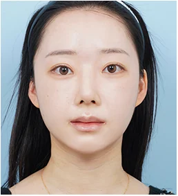 정면 30일 후