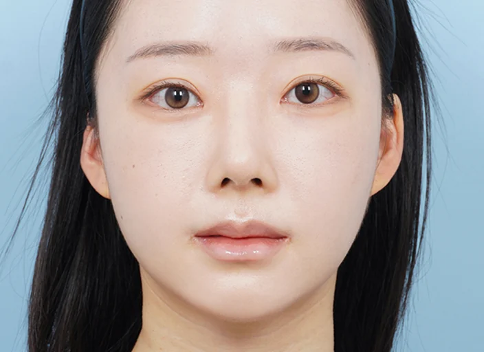 수술 4주 후 정면