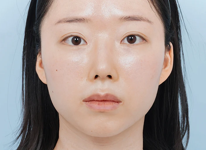 수술 전 정면