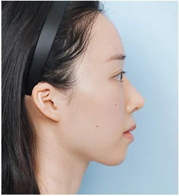 측면 수술전