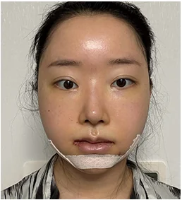 수술 3일 후 정면