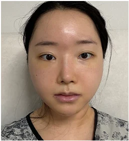 수술 5일 후 정면
