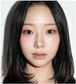 수술 30일 후 정면