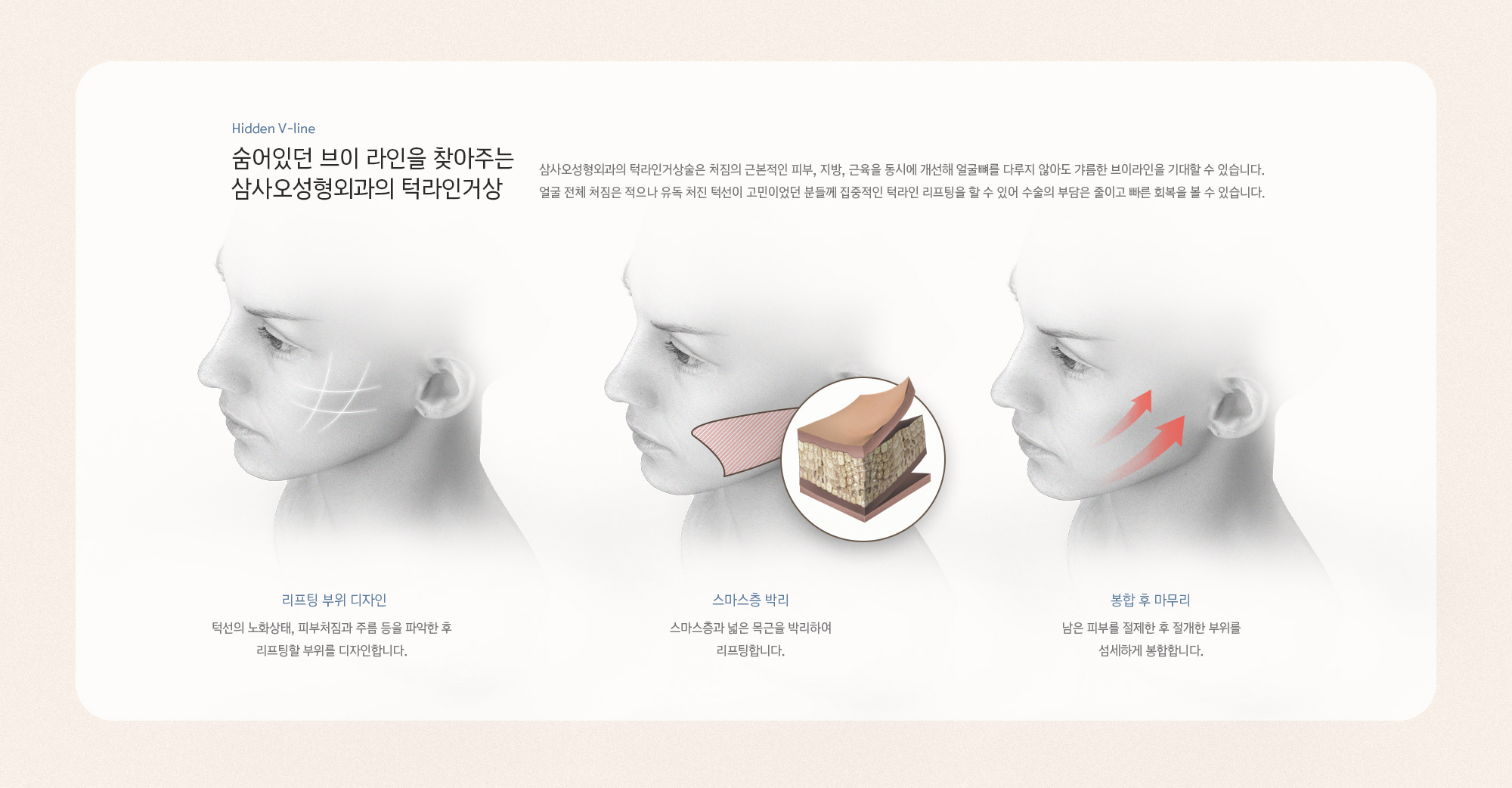 숨어있던 브이 라인을 찾아주는 삼사오성형외과의 턱라인거상. 삼사오성형외과의 턱라인거상술은 처짐의 근본적인 피부, 지방, 근육을 동시에 개선해 얼굴뼈를 다루지 않아도 갸름한 브이라인을 기대할 수 있습니다. 얼굴 전체 처짐은 적으나 유독 처진 턱선이 고민이었던 분들께 집중적인 턱라인 리프팅을 할 수 있어 수술의 부담은 줄이고 빠른 회복을 볼 수 있습니다.