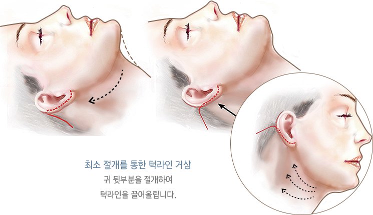 턱라인 거상 방법 이미지