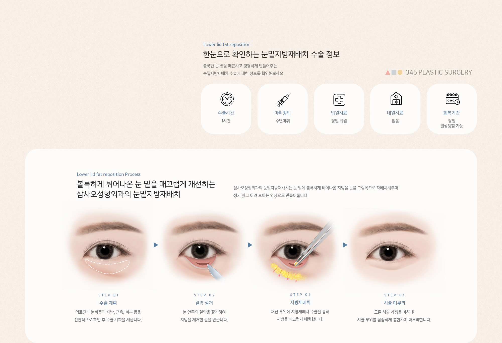 볼록하게 튀어나온 눈 밑을 매끄럽게 개선하는 삼사오성형외과의 눈밑지방재배치. 삼사오성형외과의 눈밑지방재배치는 눈 밑에 볼록하게 튀어나온 지방을 눈물 고랑쪽으로 재배치해주어 생기 있고 어려 보이는 인상으로 만들어줍니다.